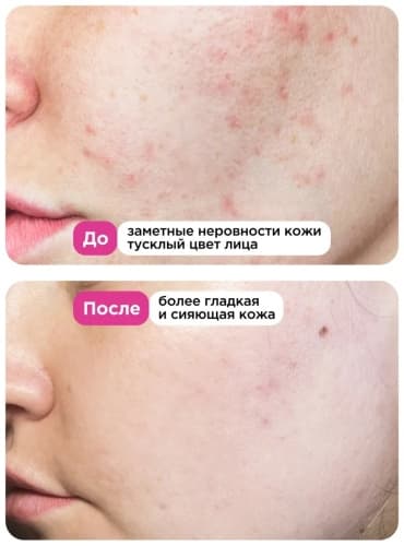 VOIS, сыворотка для лица с азелаиновой кислотой 10% от прыщей, 30 мл — фото 5